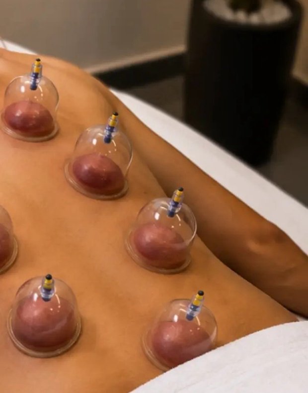 Hijama